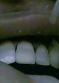 Single Tooth Replacement With Immediate Temporization In The Aesthetic Zone